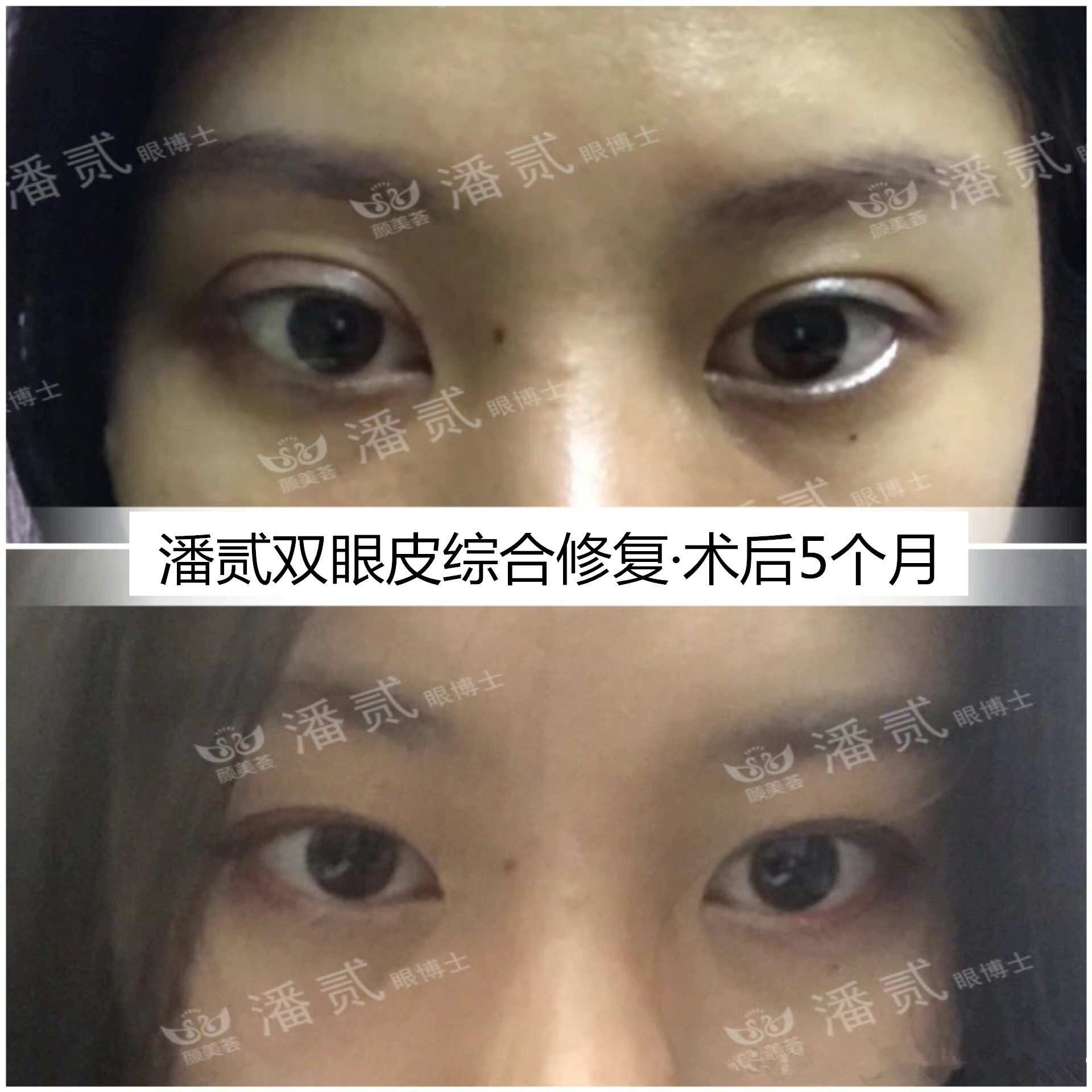 双眼皮贴导致眼皮破了,双眼皮贴导致眼皮严重下垂恢复