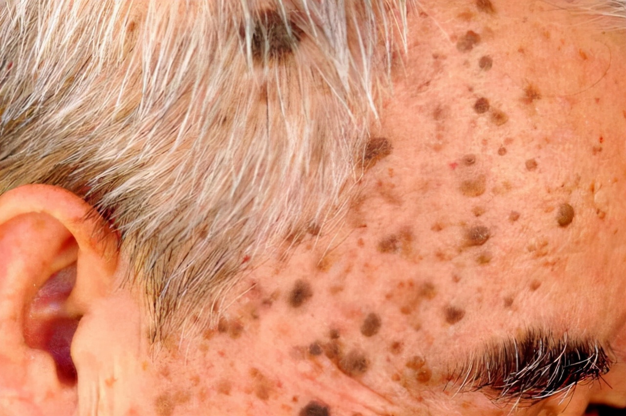 怎么用红霉素软膏祛除老年斑,快速消除老年斑的小妙招红霉素