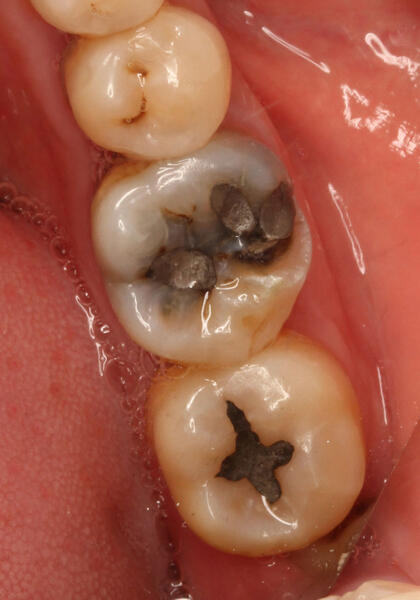 补过的牙齿可以弄掉重新补吗,补好的牙齿为什么又坏了