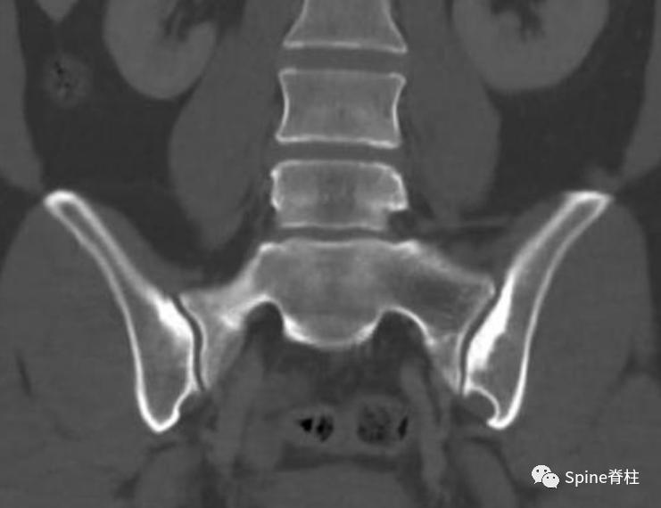 女性慢性腰痛谨防致密性髂骨炎,产后腰痛要做什么检查