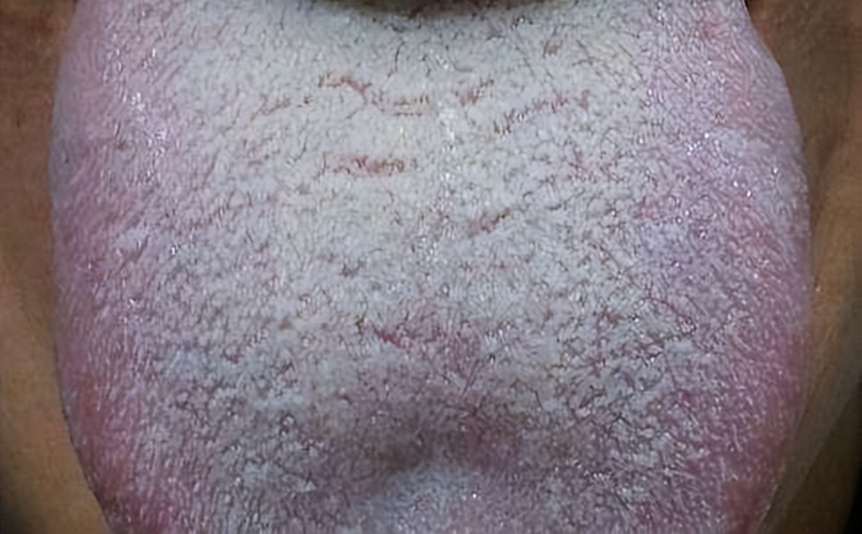 口腔溃疡反复是身体出现什么问题,反反复复口腔溃疡与哪个脏腑有关