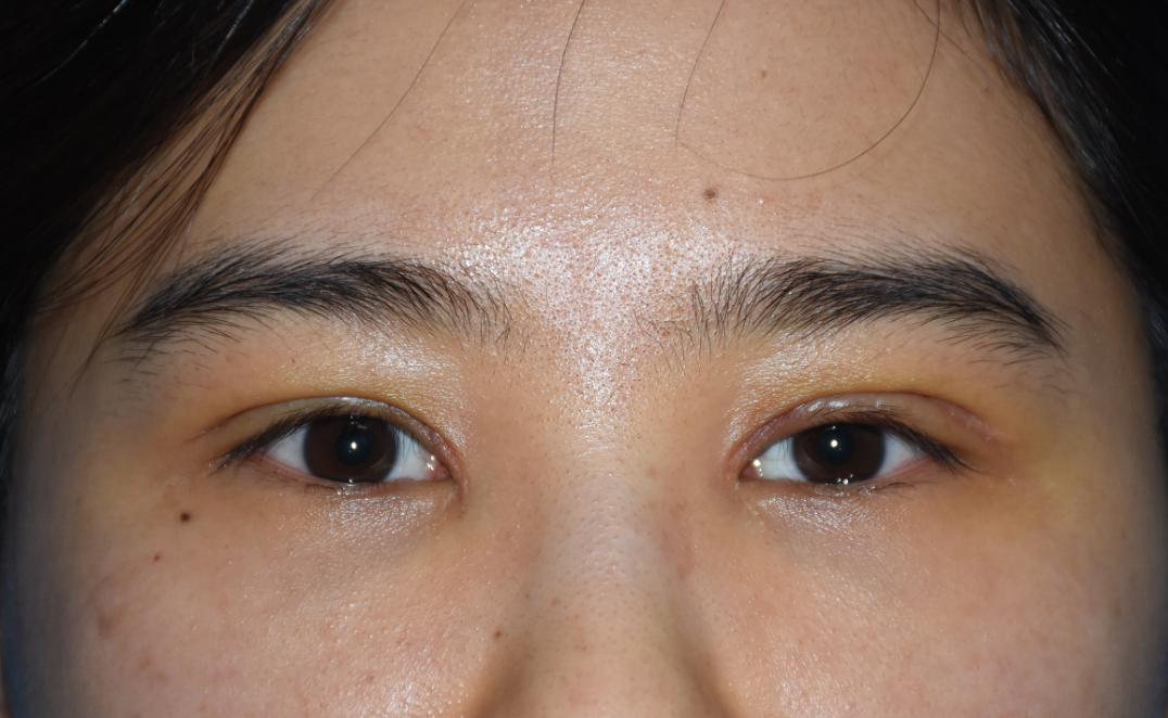 细节主义者眼中的妈生双眼皮