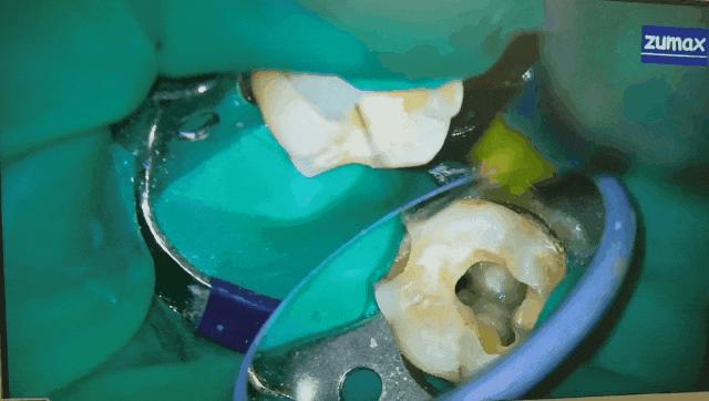 烂牙发黑根管治疗全过程,让牙齿重生的妙方