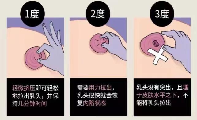 乳腺溢液最简单是什么病,乳腺溢液怎么才能知道是良性的