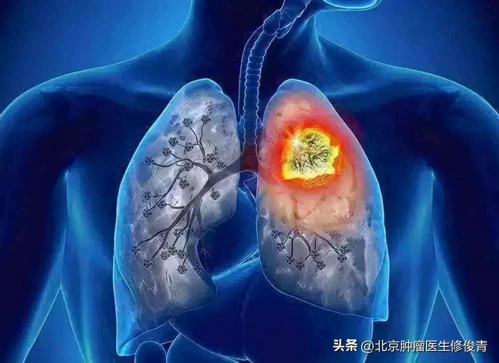 治肺结节软坚散结的药材有哪几种,消除肺结节用软坚散结的是什么药