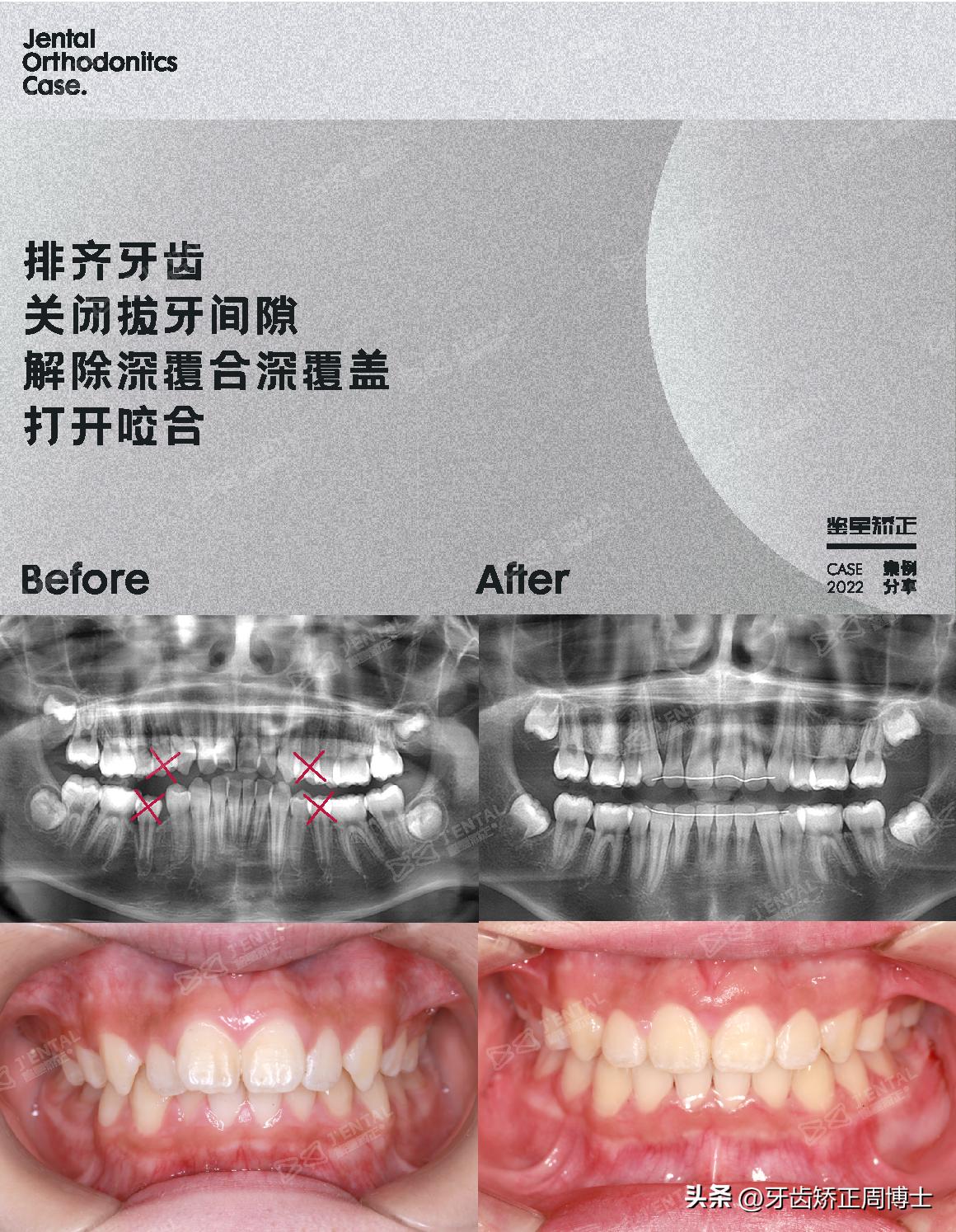 mrc戴上后不能闭上嘴怎么办,mrc矫正能用到几岁