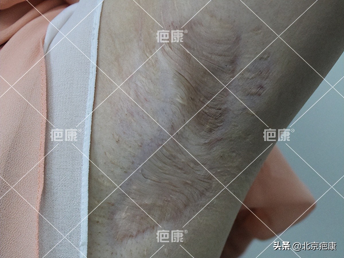 手术后刀口增生怎么办,做完腋下手术后留疤
