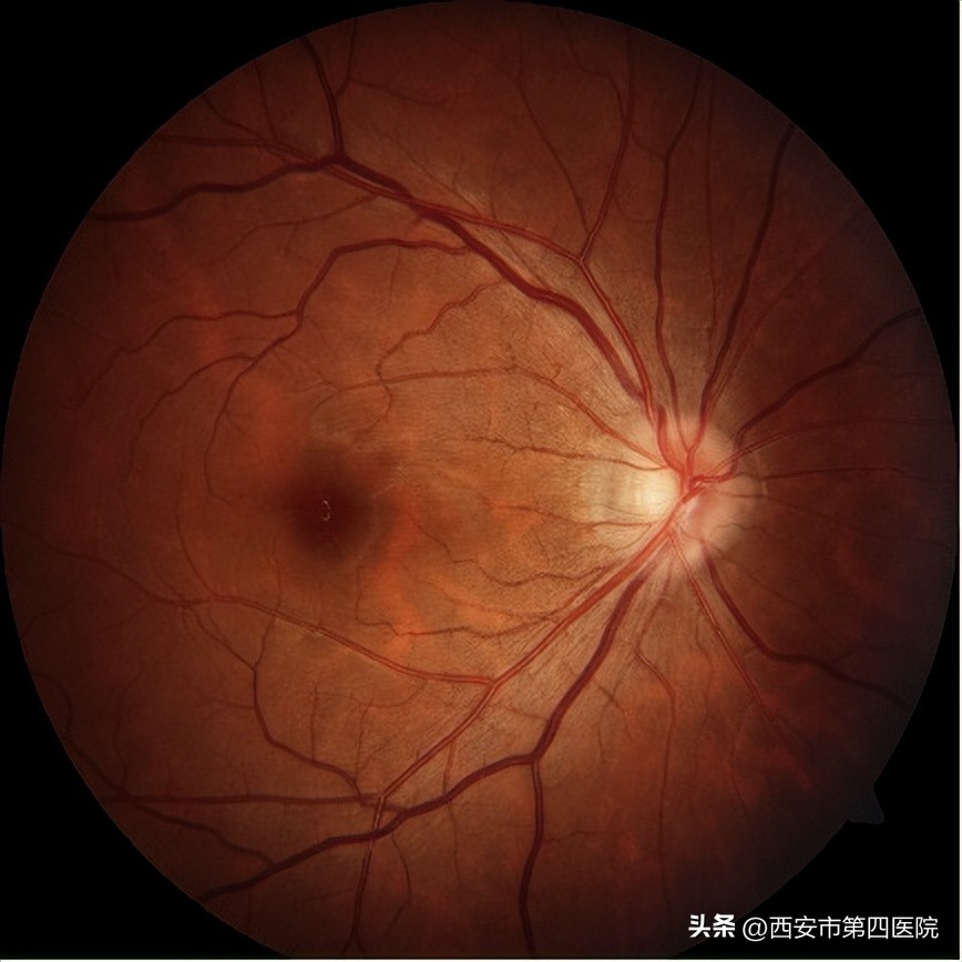 #新冠防疫手册#33岁女士“阳康”后视力下降、模糊、黑影……