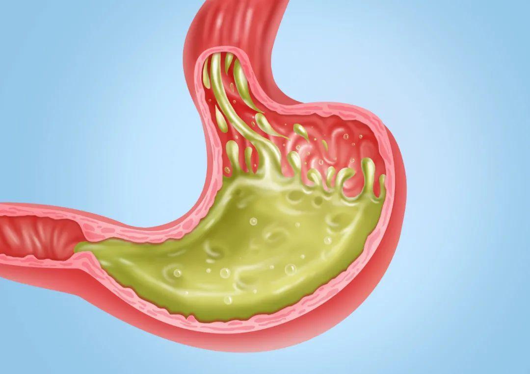 5元和50元的奥美拉唑,95块的奥美拉唑