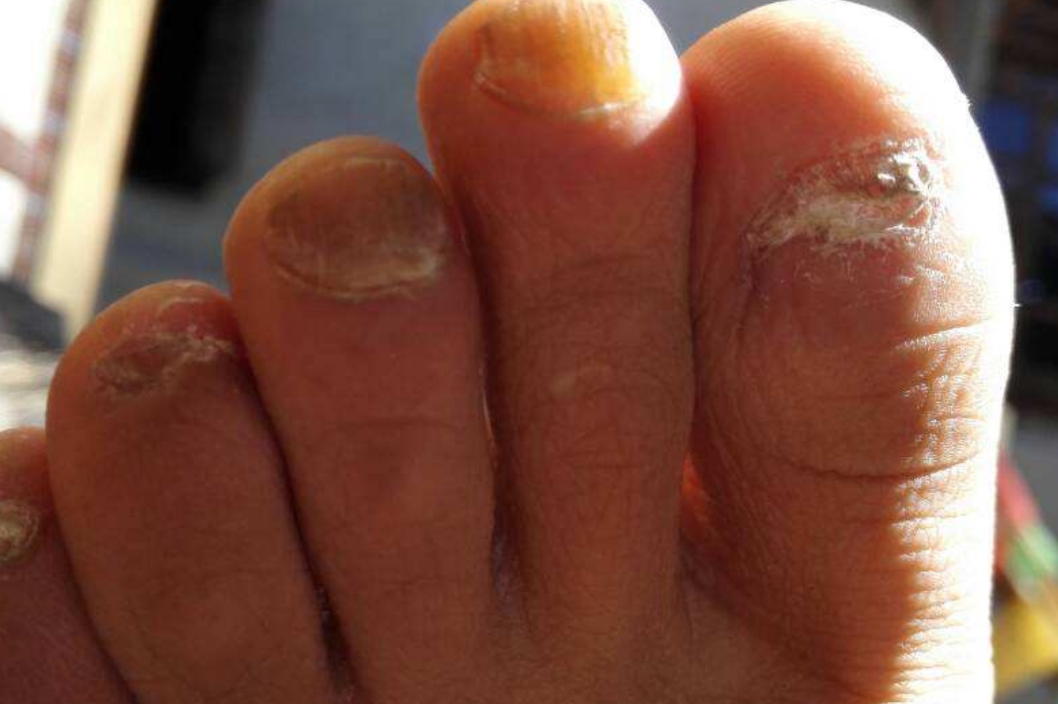 得了灰指甲别着急一个偏方,得了灰指甲去医院拔掉可以吗