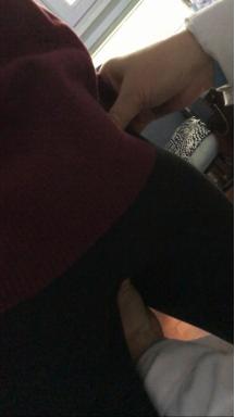 腰椎侧弯腰痛吃什么药,臀肌筋膜炎导致腰椎侧弯