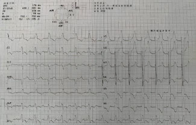 43岁心衰患者植入人工心脏,85岁老人心衰可以植入人工心脏吗