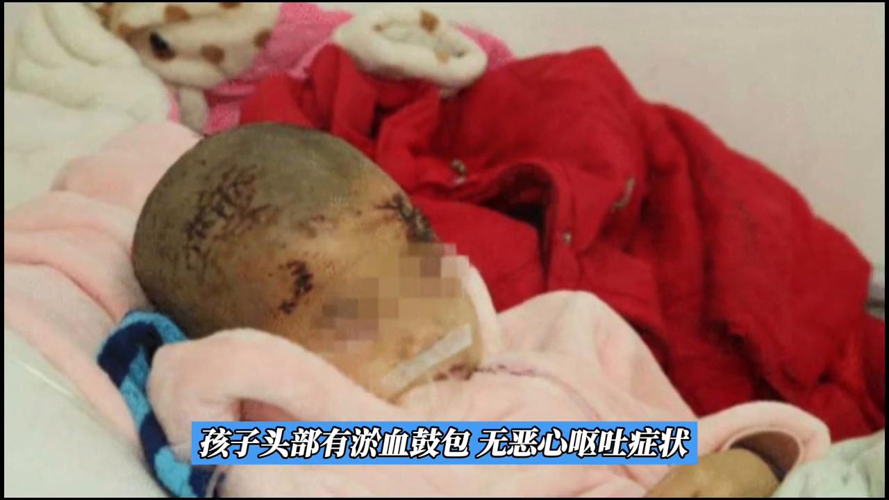 小孩头部淤血鼓包多久恢复,医生指定到外面买天价药