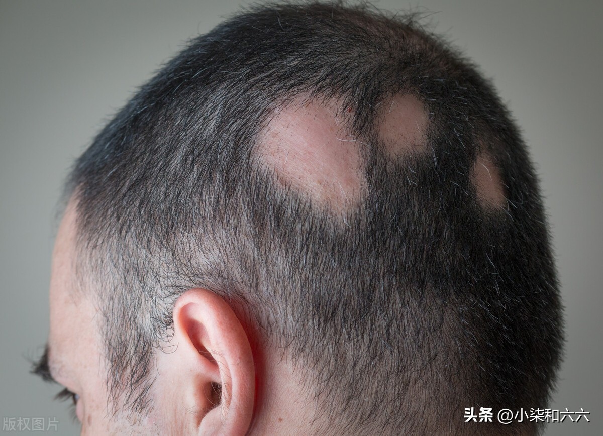 脱发该怎么办,脱发是什么原因