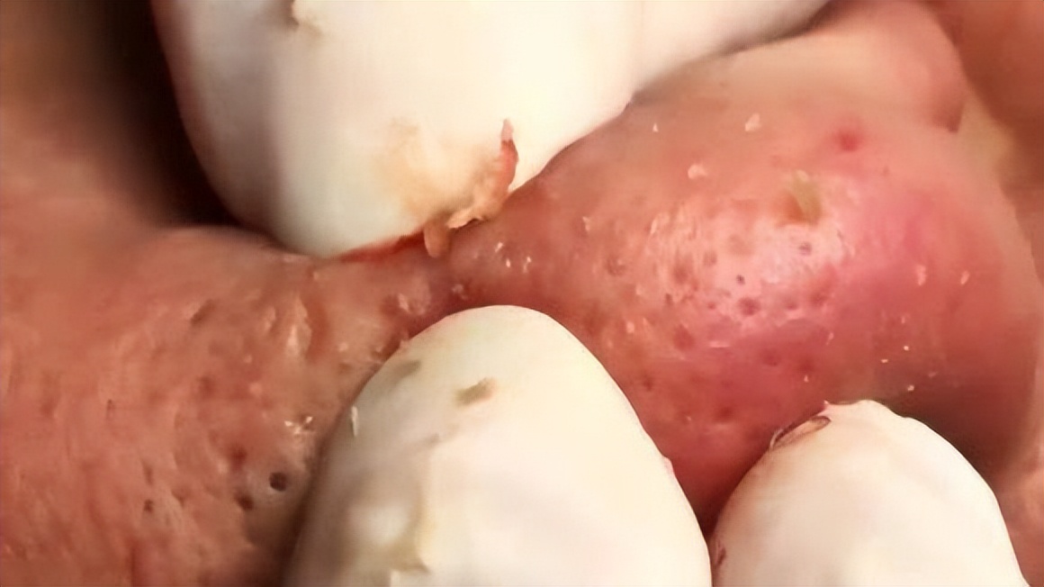 额头眉心发红有闭口粉刺,眉心鼻头频繁起粉刺怎么办