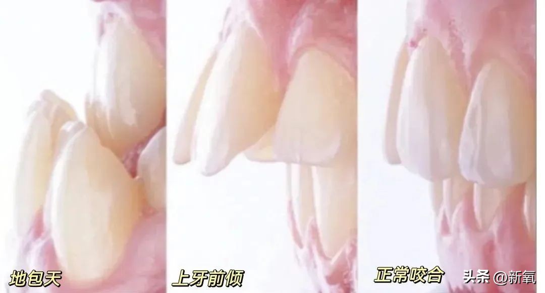 牙齿正畸和骨骼正畸的区别,牙齿正畸和眼轴增长有关系吗