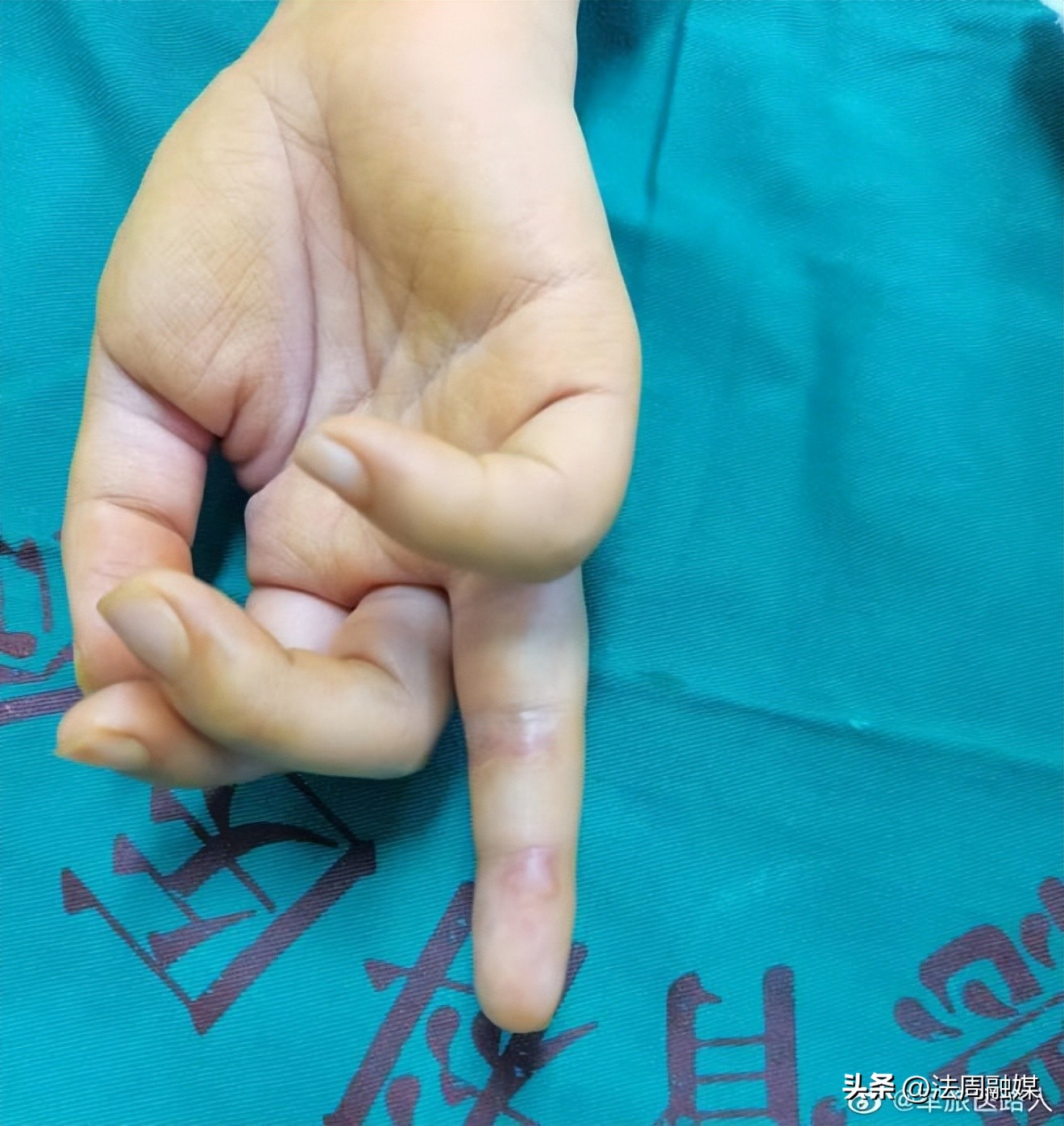 小伤口别害怕,小伤口大惊小怪