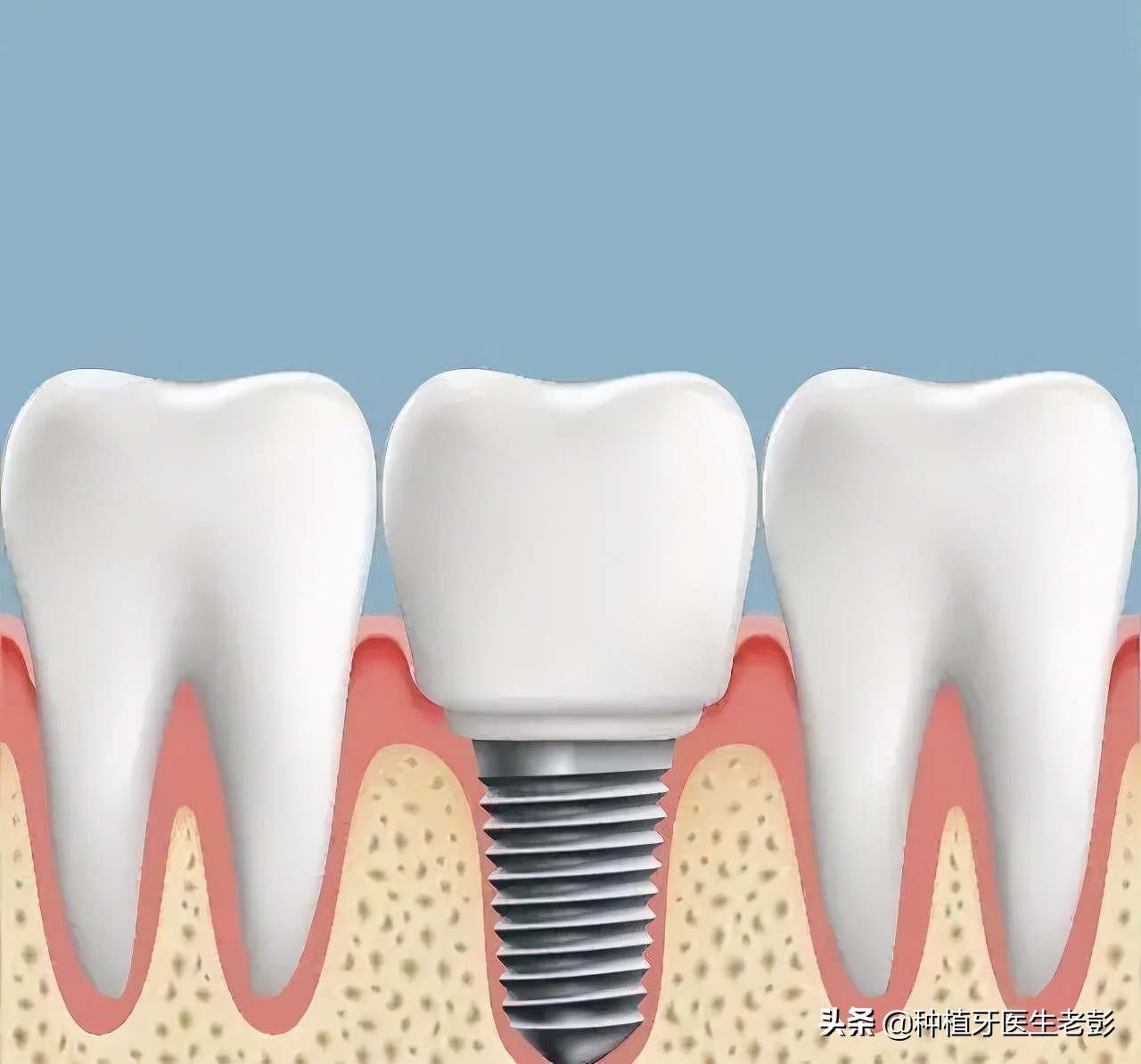 咨询医生治疗牙周炎,我想种植牙