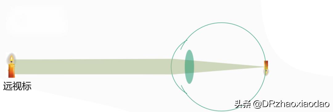 雾视治疗的最佳方法,雾视治疗是什么意思