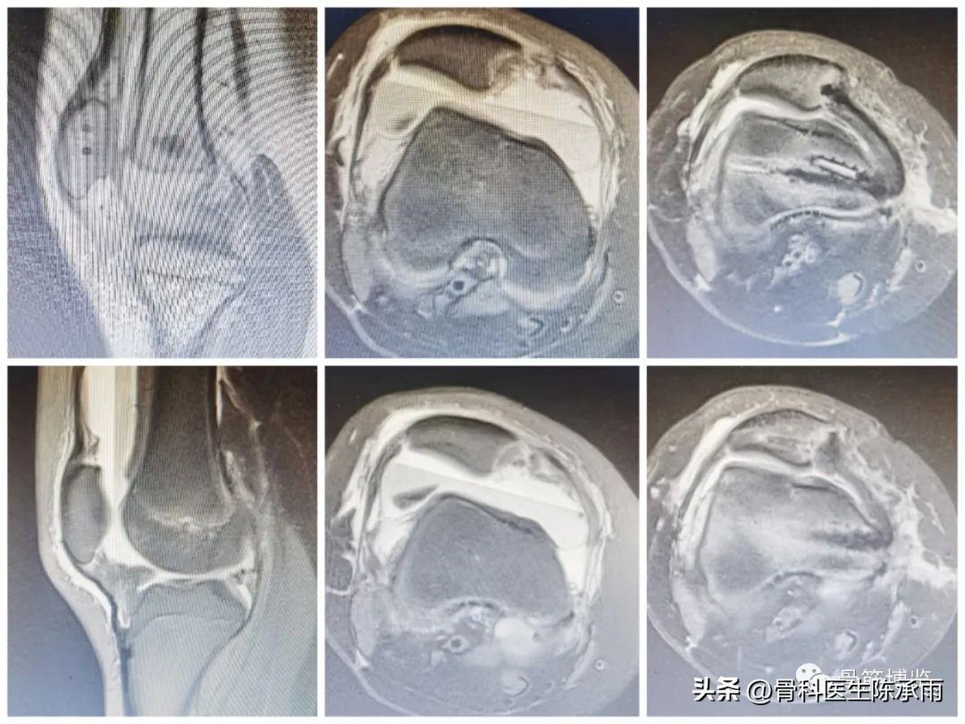 髌骨脱位保守康复训练具体步骤,髌骨脱位重建手术全过程