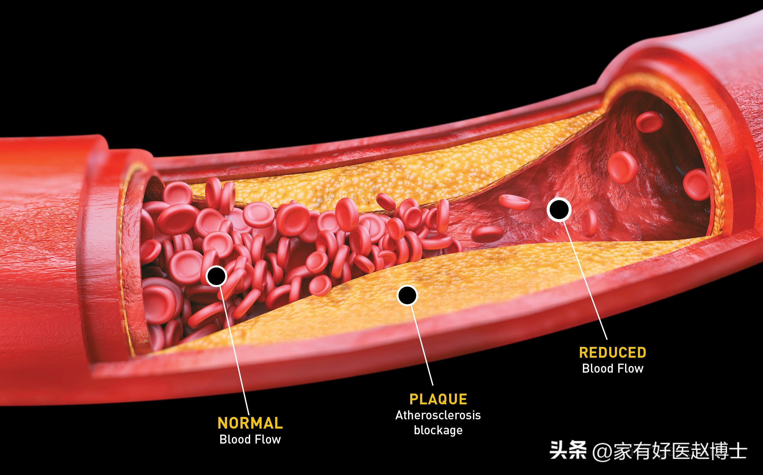颈动脉没有斑块可以停用他汀吗,一般他汀吃多久颈动脉斑块有效果