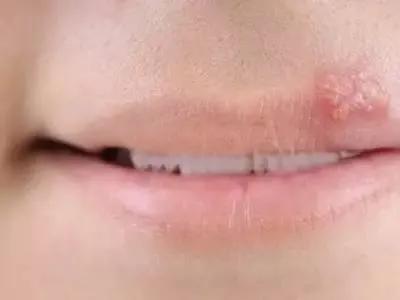 嘴巴起泡可能是单纯的疱疹病毒,得了疱疹嘴巴里全是泡该怎么办