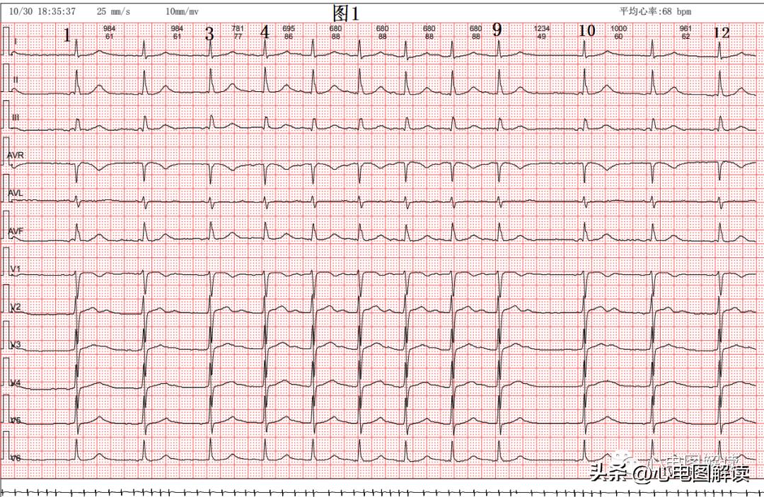 窦房结至心房之间的游走心律、房性心律的诱发原因之一