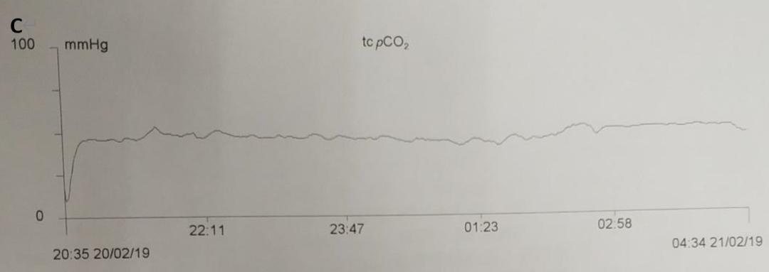 几十年间歇性胸闷气短去哪治疗,胸闷气短三年了怎么回事
