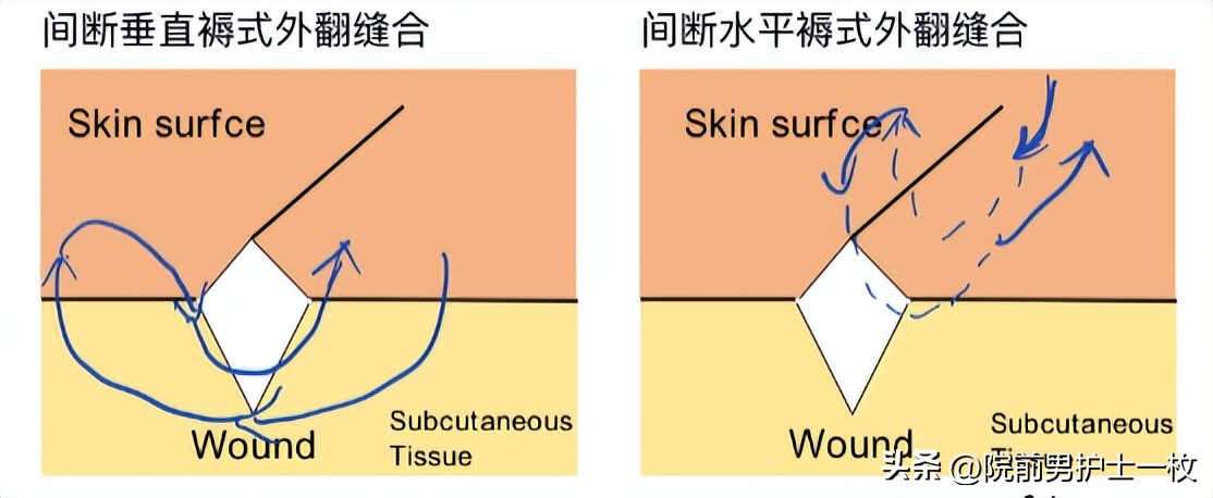 关于急诊清创缝合术必须掌握知识