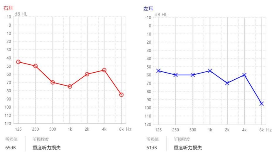 耳聋重度带助听器管用吗,重度耳聋有必要佩戴助听器吗