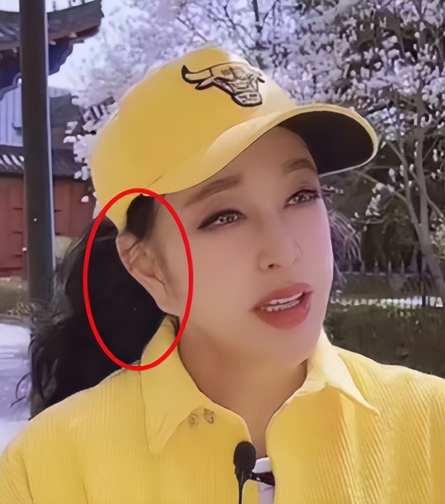 明星下颚骨整容后遗症,脸像鞋拔子怎么改善