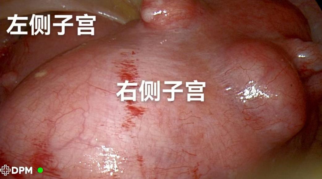 双子宫切除一个畸形采取什么手术,双子宫手术是大手术还是小手术