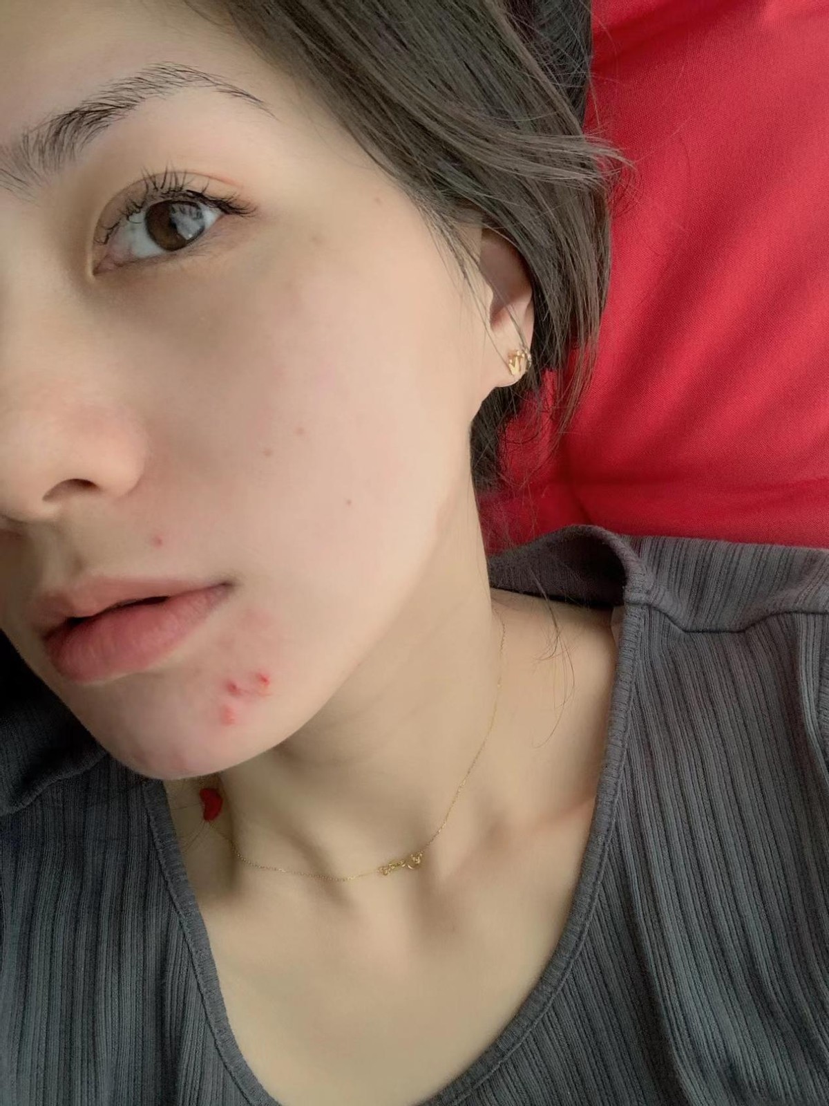 下巴总长痘痘抹什么药,下巴总长痘痘和闭口怎么办