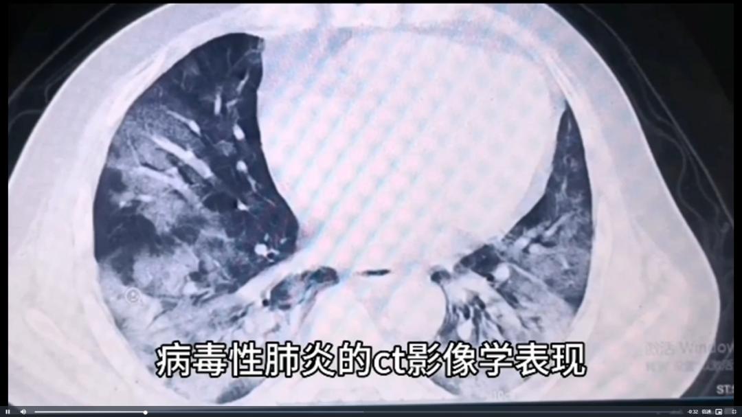 白肺，心肌炎，沉默性缺氧！感染之后这些事一定要注意了！