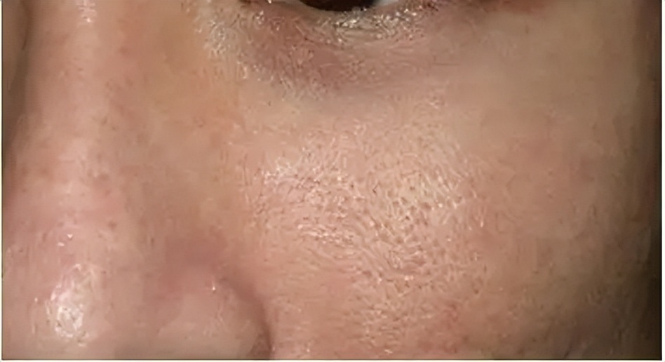 阿达帕林怎么改善毛孔粗大,葛林若美白方法