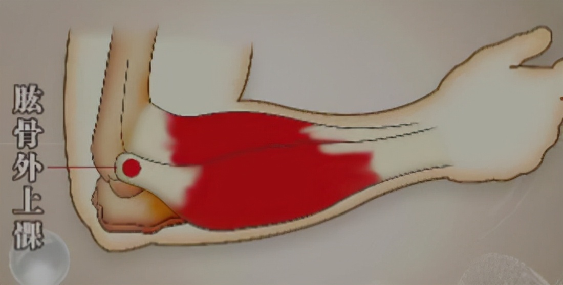 网球肘手术需要注意什么,网球肘久治不愈可手术