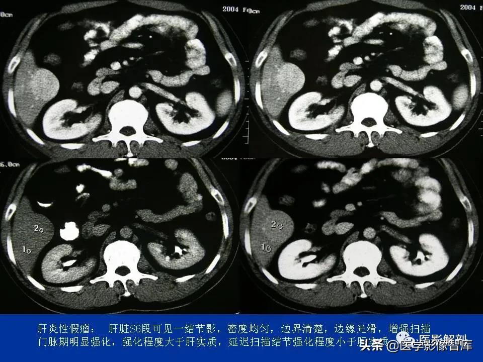 肝炎性假瘤鉴别诊断,肝炎性假瘤影像学表现