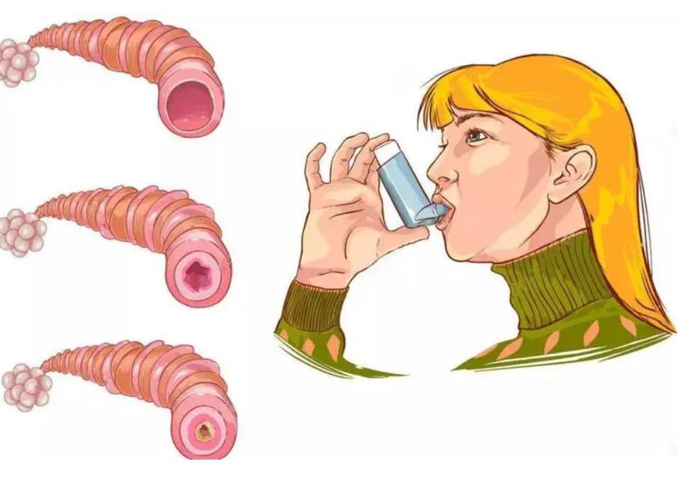 尘螨过敏脱敏治疗医保报销吗,尘螨1级过敏需要脱敏治疗吗