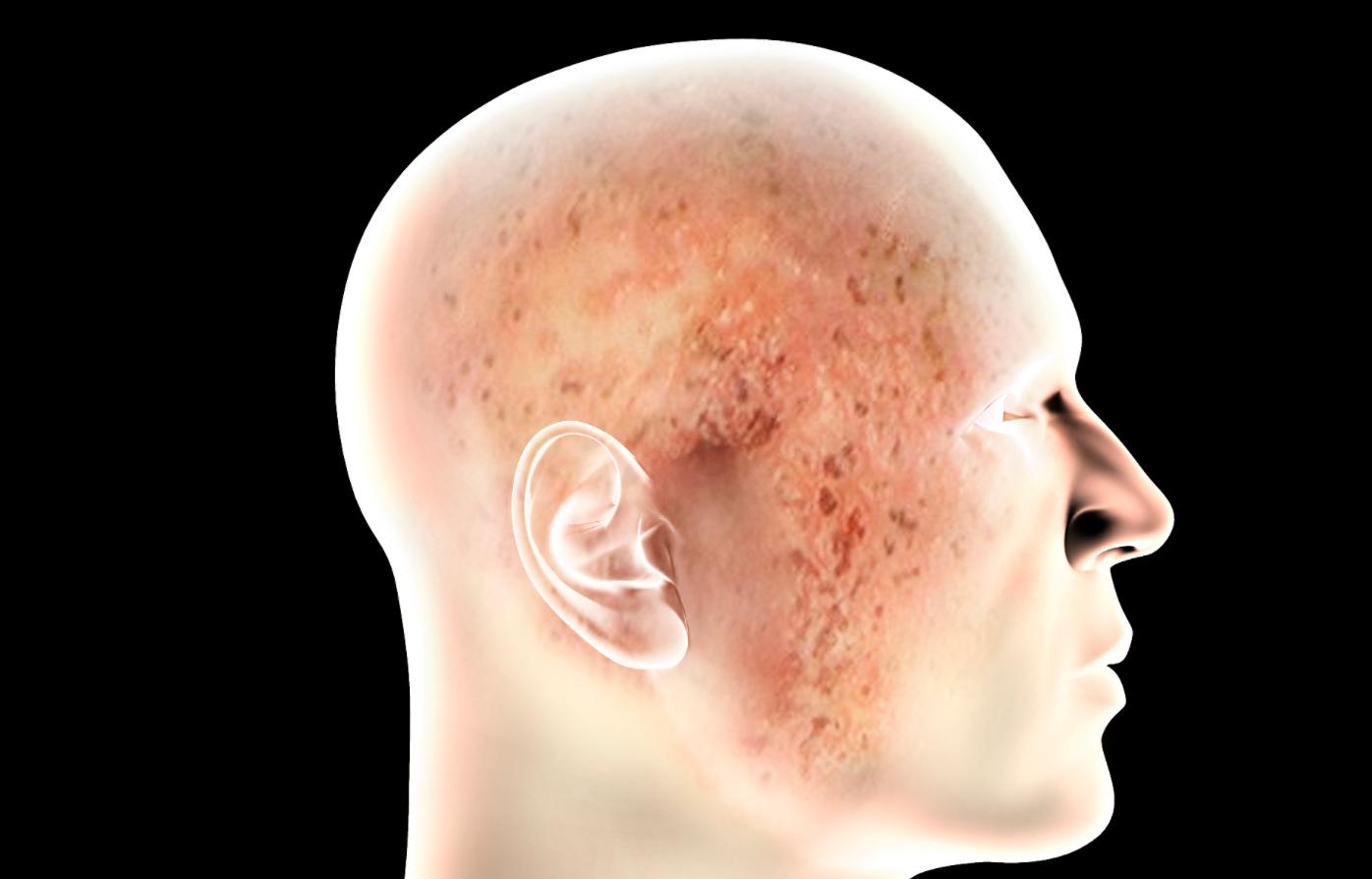 耳朵痒一掏就流水有臭味用什么药,耳朵老是痒天天都要掏怎么回事