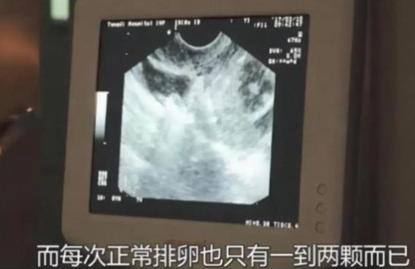 卖卵*市黑**盯准高颜值高学历女大学生，不麻醉，长针直接穿刺