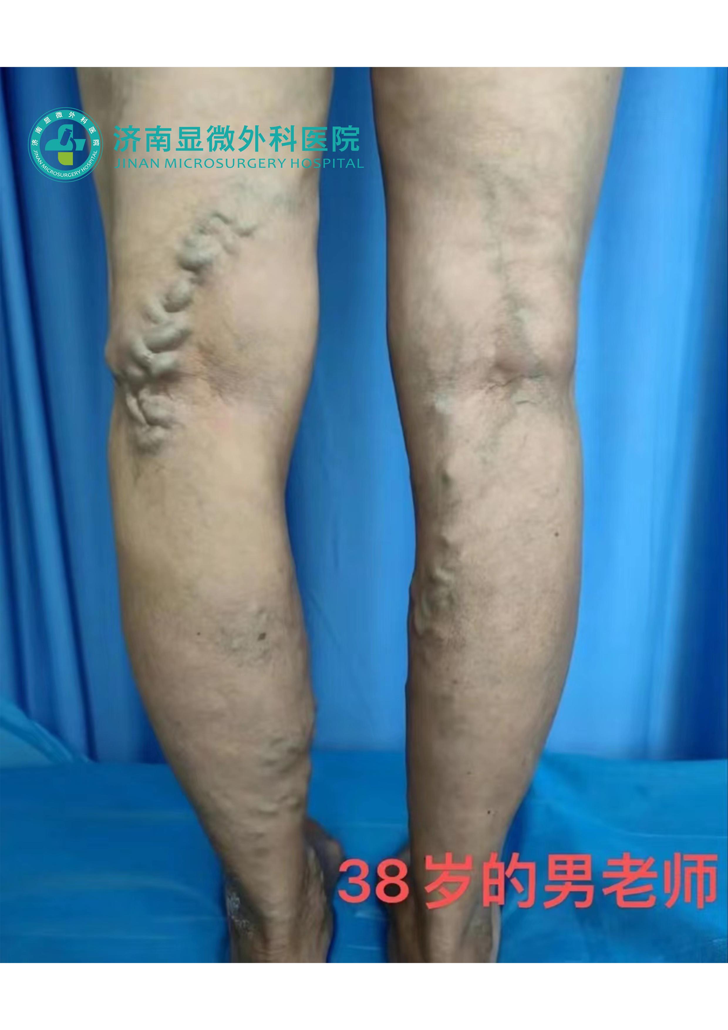 静脉曲张运动疗法的视频,静脉曲张保健手法