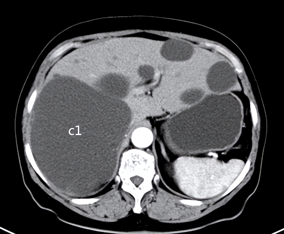 专家讲解多发肝囊肿治疗视频,多发性肝囊肿适合什么手术