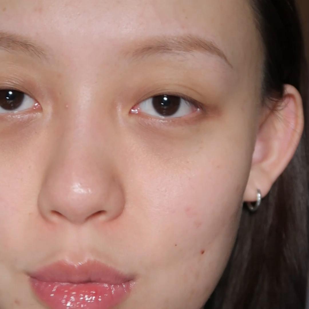 痘肌祛闭口的最好方法,闭口混合痘肌如何护肤