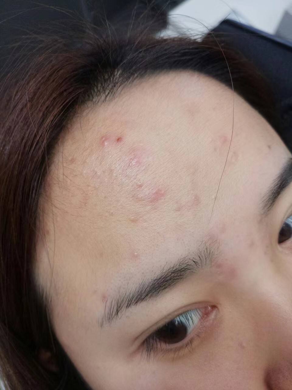 痘痘的10大常见说法你了解多少,关于痘痘的科普知识有哪些