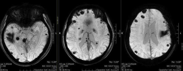 3岁男孩颅内肿瘤,33岁小伙肿瘤