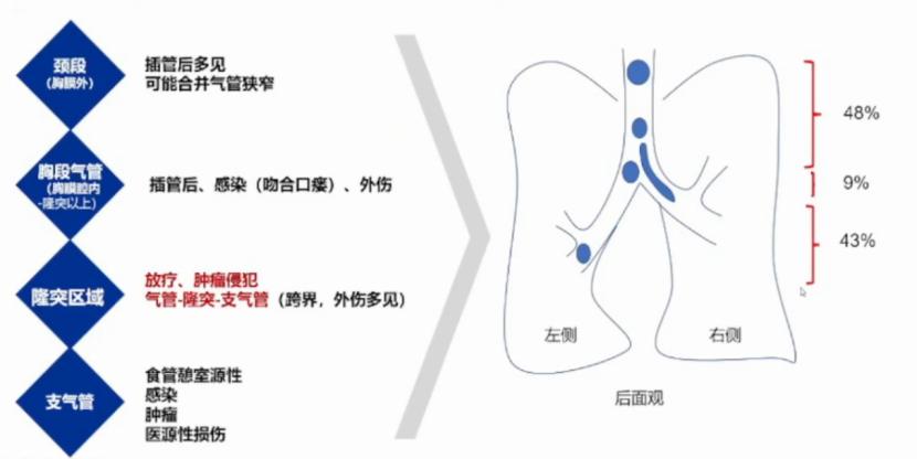 吴镜湘教授：胸科手术“下气道困难”的麻醉管理