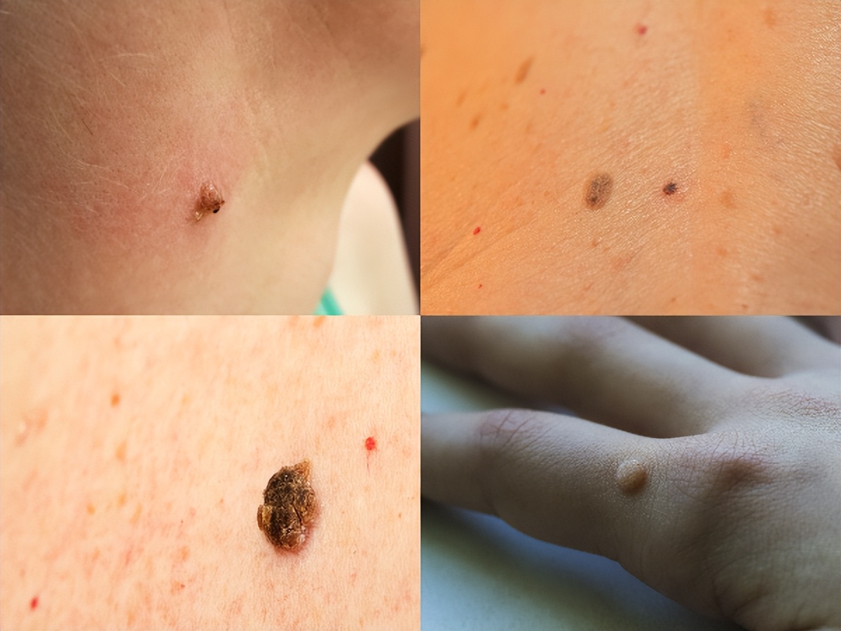 肉芽长满了会怎样呢,肉芽长得慢怎么办