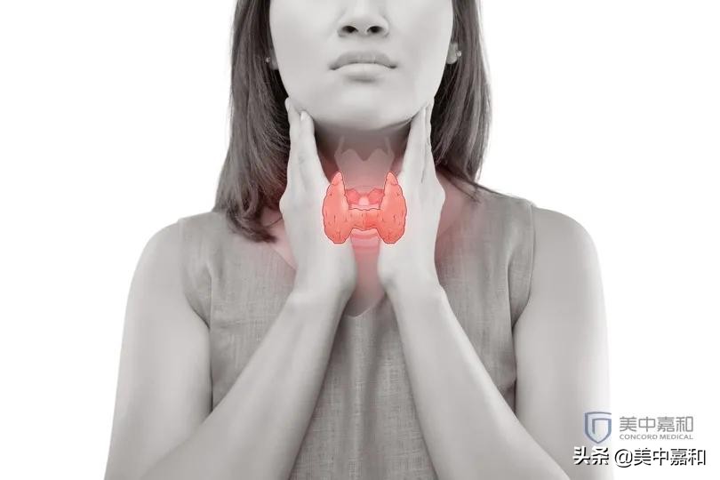 甲状腺肿就只想到“大脖子”？卵巢表示不服