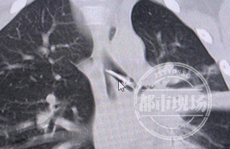 孩子误吞图钉怎么办,八岁男孩误吞图钉