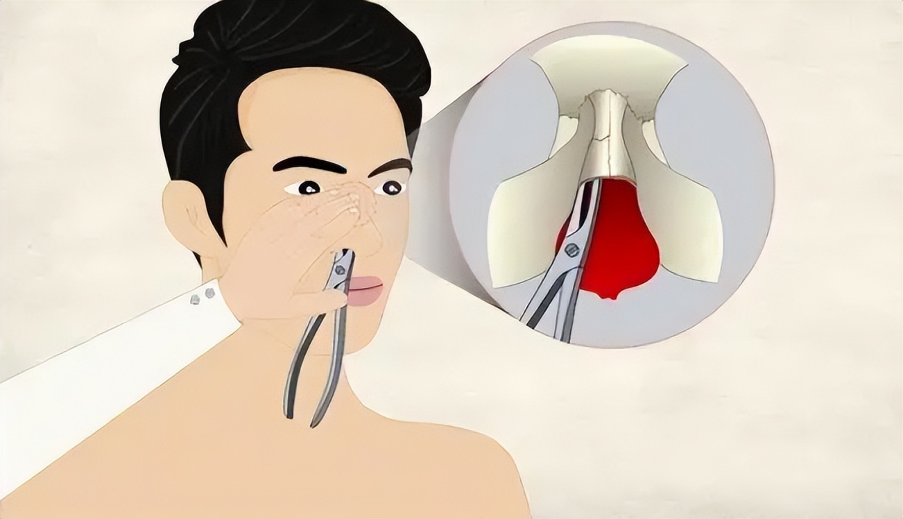 运动后鼻子出血的原因,运动后鼻子不舒服怎么办